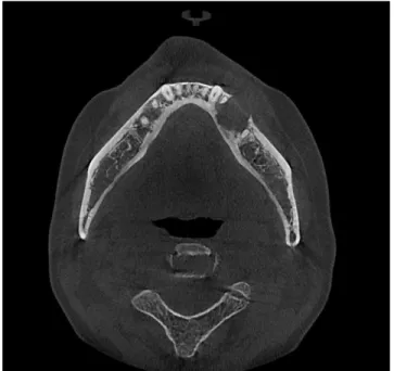 Fig.  3. Panoramic  radiograph  after  #34  RCT.