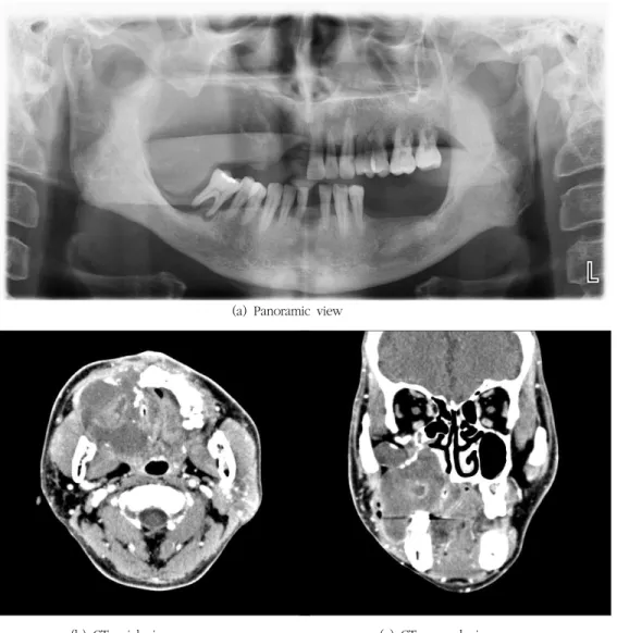 Fig.  2.  Radiographic  features.  Panoramic  image  shows  a  mixed  radiolucent  radiopaque  lesion  with  partially  ill-defined  borders  in  the  right  maxilla