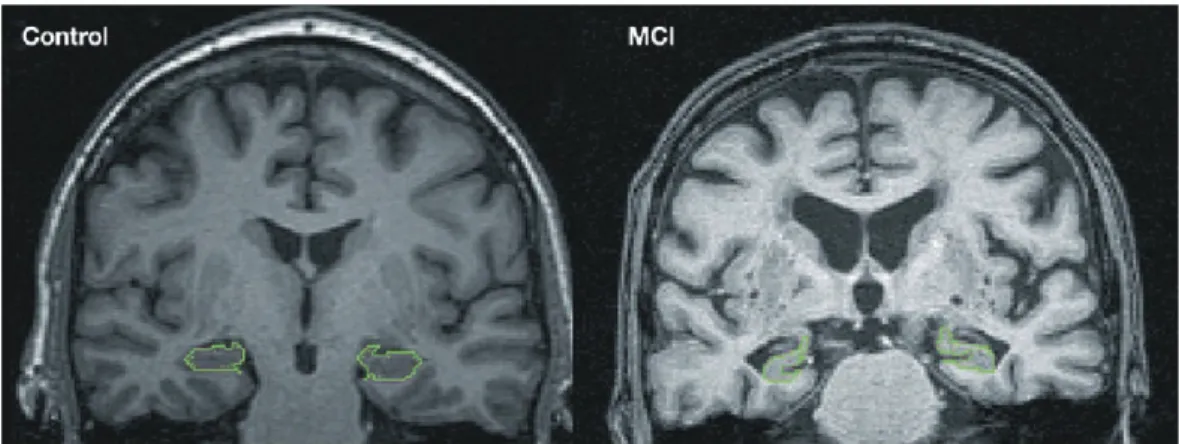 Figure  4.  MCI에서의  해마체  체적의  감소(Nestor,  2004에서  참조). 50)