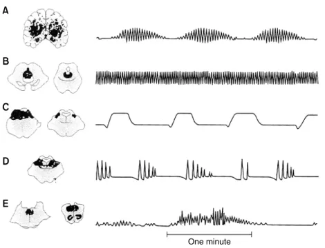 Figure  1.  Abnormal  respiratory  patterns  associated  with  pathologic  lesions  (shaded  areas)  at  various  levels  of  the  brain