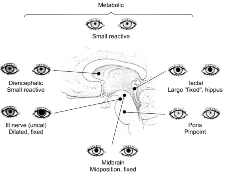 Figure  2.  Pupils  in  comatose  patients. 이 생기지 않는다.  구상회탈출(uncal  herniation)이 동안신경을 누르거나 내경동맥 동맥류가 터지면 동공이  커지고 결국 동공반사가 없어지게 된다