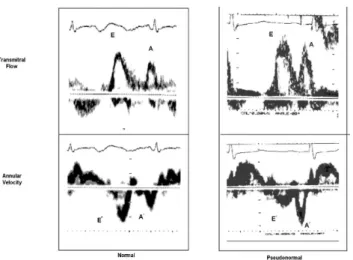 Figure  4.  Comparison  of  normal  transmitral  flow  and  mitral  annular  velocity  with  those  in  pseudonormal  diastolic  dysfunction.