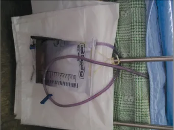Figure  1.  Purple  urine  bag  and  catheter  (purple).