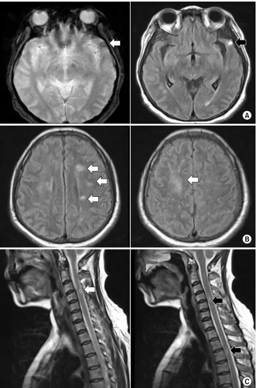 Figure 1. Brain (A, B) and spinal  (C) magnetic resonance imaging. 