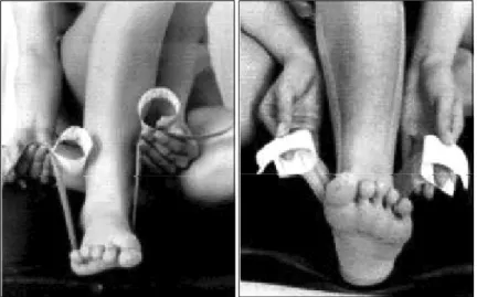 Figure  2.  The  method  of  ankle-taping.