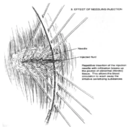 Figure  3.  Repetitive  insertion  of  the  injection  needle  with  infiltration  breaks  up  the  pocket  of  abnormal  (fibrotic)  tissue.