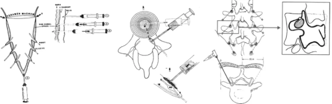 Figure  10.  고식적  또는  추간공을  통한  선택적  요추  신경근의  경막외  스테로이드  주사법과  고주파  열치료.