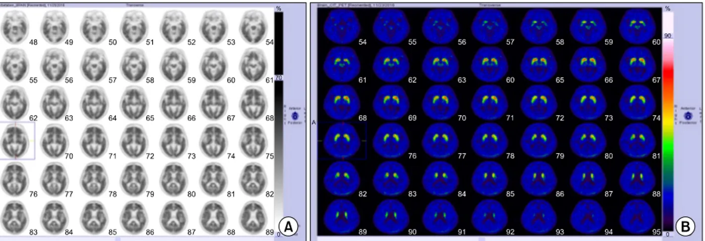 Figure 2. (A) F-18 Florbetaben PET showed diffuse florbetaben uptake on bilateral lateral temporal cortex, frontal cortex, parietal  cortex, and precuneus/posterior cingulate regions