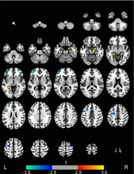 Figure 1. Brain regions with increases (red-yellow) or decreases  (blue-green) in regional cerebral blood flow in patients with  mixed dementia compared to those with Alzheimer’s disease