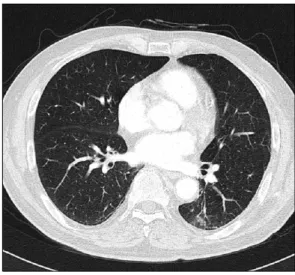 Figure  1.  RUL  Tb  sequelae. Figure  2.  LLL  pneumonia,  bronchiectasis.