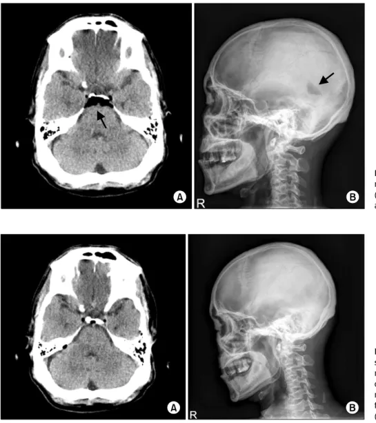 Figure 1. Brain CT shows pneu- pneu-mocephalus in suprasellar cistern  (A). Skull lateral shows ventricular air density (B).
