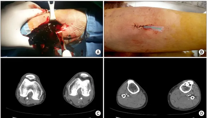 Figure 3. Resolution of pseudoaneurysm and hematoma by surgical drainage. (A, B) Incision and drainage of pseudoaneurysm and hematoma