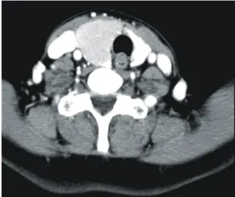 Figure  1.  Marked  enlargement  of  right  lobe  of  the  thyroid  and  relatively  heterogeneity