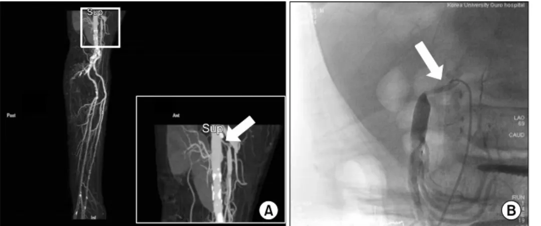 Figure 1. Severe stenosis in  proximal superior mesenteric  artery in lower extremity computed tomography (A) and superior  mesenteric artery diagnostic  an-giography (B)