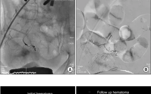 Figure 2. Selective multiple coil  embolization using Tornado micro  coils (A). Successful coil  embo-lization and complete hemostasis  was confirmed by digital  subtr-action angiography image (B).