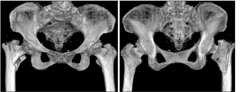 Figure  1.  HAD1)  Rt.  inter- inter-trochanter  fx.  in  Pelvic  3D  CT.