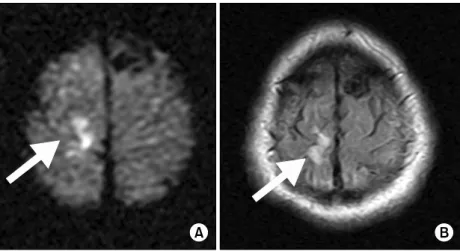 Figure  1.  Brain  MRI  of  the  patient.  Diffusion-weighted  (A)  and  T2-weighted   fluid-atten-uated  inversion  recovery   (FL-AIR,  B)  images  show  small  infarction  in  the  right   precen-tral  cortex