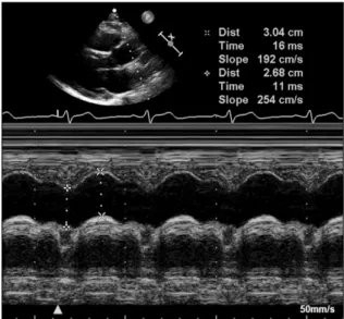 Figure  1.  Measurement  of  the  internal  aortic  diameters  from  the  2-dimensional  guided  M-mode  tracing