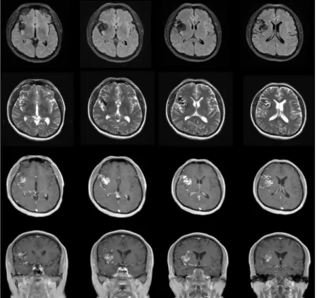 Figure  1.  The  brain  MRI  shows  arteriovenous  malformation  in  the  right  insular  lobe  that  was  presented  clustered  dilated  vessels  in  right  insular  lobe  and  sylvian  fissure  area  and  dilatation  of  vein  in  right  frontotemporal  