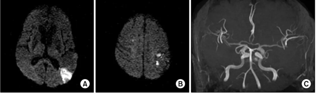 Figure  1.  Diffusion  weighted  image  showed  multiple  acute  infarctions  in  left  cerebral  hemisphere  (A,  B)