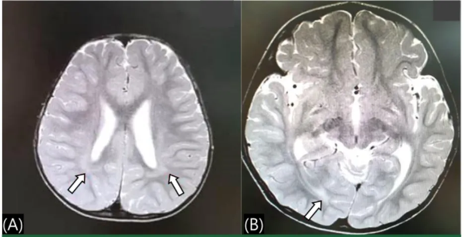 Fig. 2. Brain magnetic resonance imaging showed mild bilateral peritrigonal white matter  volume loss (A) and suspicious subcortical white matter signal change in the right occipital  lobe (B).