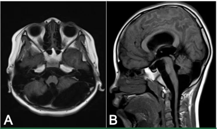 Fig. 1. Diffuse black pigmented nevi of various sizes on the whole body.