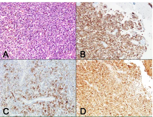 Fig. 5. Pathological morphology features and immunohistochemistry results of the brain biopsy speci- speci-men (x200)