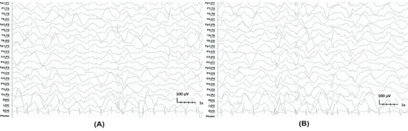Fig. 2. Electroencephalography of the patient on admission showed diffuse dysmorphic and slow delta background activities with  bilateral independent frontal sharps (A and B with sharps from the right and left frontal areas, respectively).