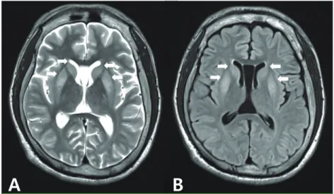 Fig. 1. MRI showed symmetric T2 and T1 signal changes in the bilateral caudate head and  putamen, sparing the globus (A, B).