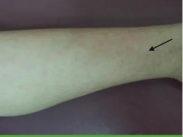 Fig. 1. Reticular erythema on a lower extremity (arrow) at the time of  emergency room arrival.