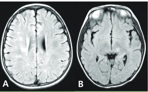 Fig. 3.  Brain MRI at second relapse. Newly developed FLAIR hyperintense lesions in the bilateral subcor- subcor-tical white matter, periventricular white matter, left thalamus, brain stem, middle cerebellar peduncle,  and cerebellar vermis.