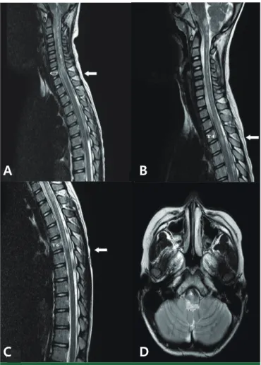 Fig. 1. Spinal magnetic resonance imaging (MRI) showed ill-defined  high signal intensity lesions in the lower medulla and whole cervical  cord (C1-7) on the sagittal view of T2-weighted image at initial  admis-sion (A)