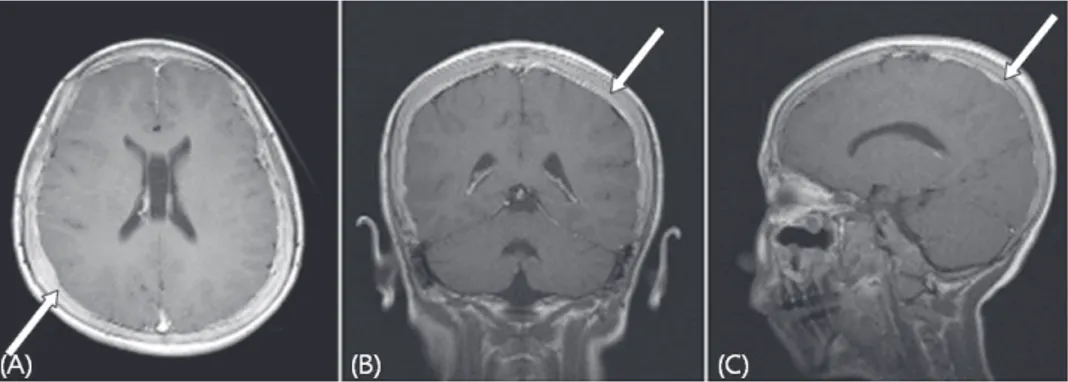 Fig.  1.  Magnetic  resonance  imaging  shows  diffuse  dural  thickening  with  enhance- enhance-ment  (A,  B,  C)