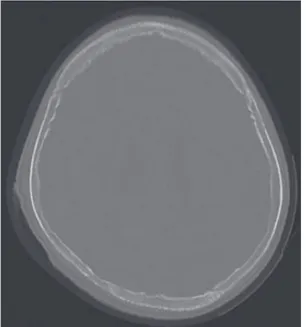 Fig.  2.  Brain  computerized  tomography  (CT) shows  diffuse  osteolytic  bony  changes  in 