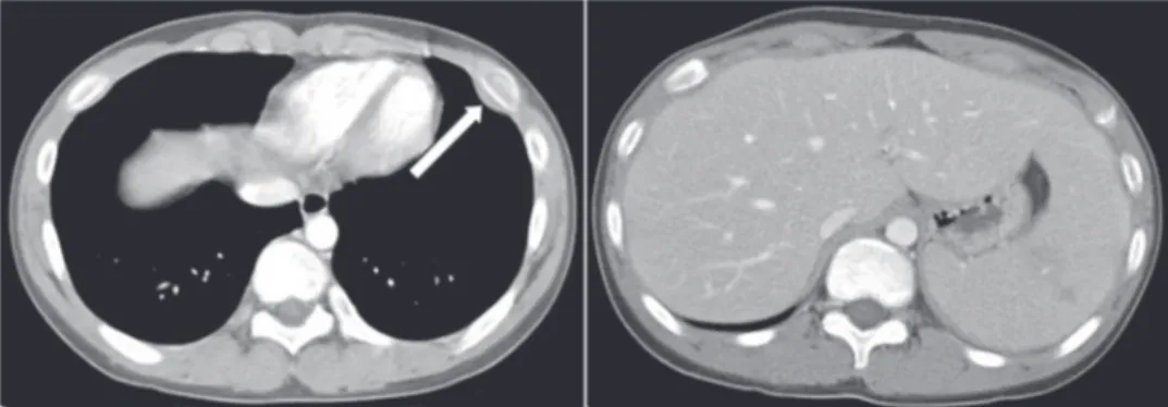 Fig.  3.  Chest  CT  shows  soft  tissue  mass  (white  arrow)  with  osteolytic  bony  destruction  in  left  6th  anterior  rib  (A)