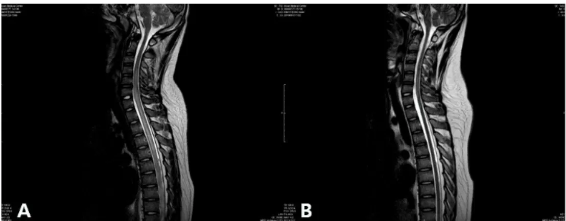 Fig. 1. (A) A high T2WI signal intensity from the C3-4 to the T10-11 segments of spinal cord suggests myelitis