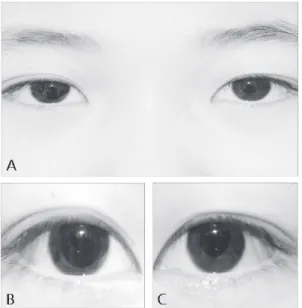 Fig. 2. Cholinergic  denervation  supersensitivity was  positive.  Right  pupil  constricted  after   in-stillation  of  0.125%  pilocarpine.