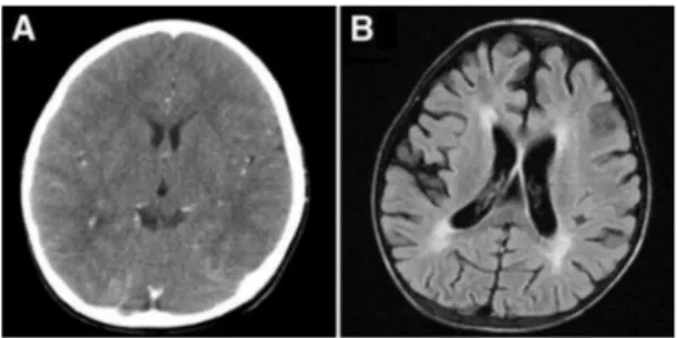 Fig. 3 A and B. (A) Computed tomography (CT) image of the third patient at diagnosis shows normal findings