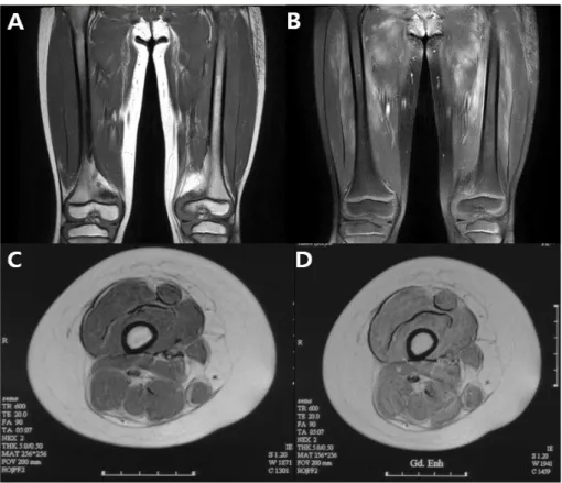 Fig. 2. Leg MRI of the representative cases. A and B: female, five-year-old.