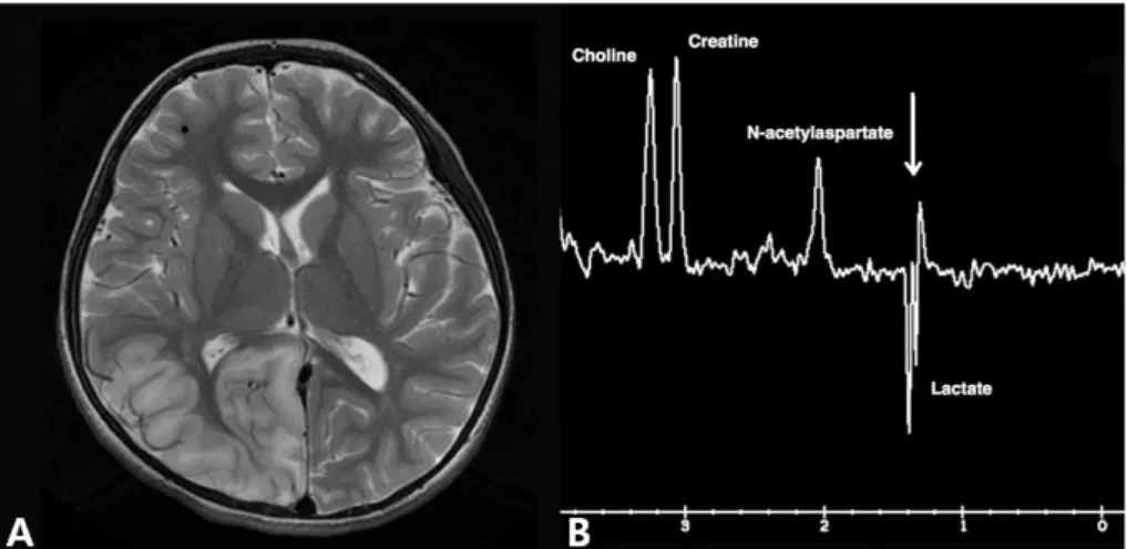 Fig. 1. Brain MRI and MR spectroscopy of the patient. Brain MRI shows diffuse cerebral atrophy and high signal in right temporal, parietal and occipital area on T2 weighted image (A)