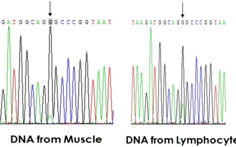 Fig. 2. mtDNA sequencing of the patient. Direct sequencing of mtDNA in blood and muscle specimens revealed mtDNA A3243G mutation.