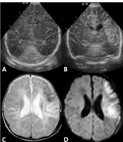 Fig. 1. Brain  ultrasonography  (USG)  and  MRI  findings  in  patient  13.  (A)  Brain  USG  on  the  first  day  of  life,  coronal  section,   re-vealed  no  abnormality