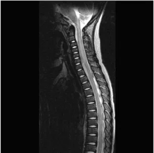 Fig. 1.  T2  sagittal  image  of  a  patient's  spine  MRI.  Spine  MRI  revealed  high  signal  intensity  and  swelling  at  C3-C6.족구병의  대규모  발생이  있었고,  당시  사망률은  매우 높았으며 특히 3세 이전의 소아에서 가장 높았다2, 3)