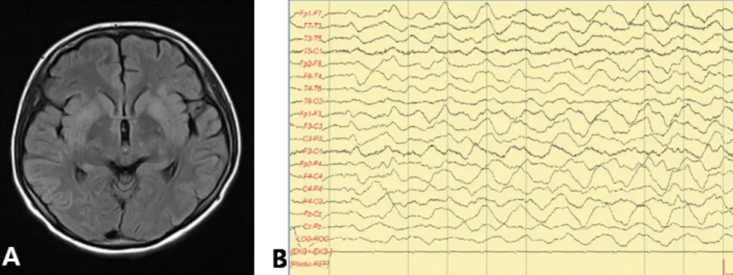 Fig. 1. (A) Axial brain MRI of patient 1. Fluid attenuated inversion recovery (FLAIR) image showing multiple cortical swelling and a high intensity signal in the cerebral cortex and basal ganglia