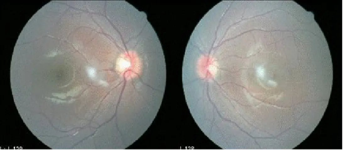 Fig. 2. Fundus photograph 8 months after treatment shows no interval change.