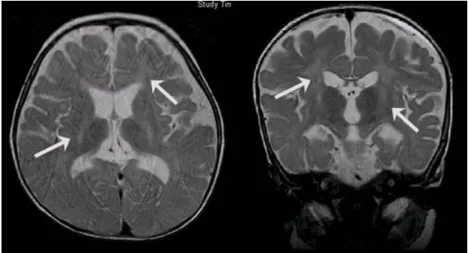Fig. 1. The T2 weighted axial and coronal images showed abnormal high signal intensity in the posterior rim of the internal capsule, bilaterally, and in the deep white matter(arrows).