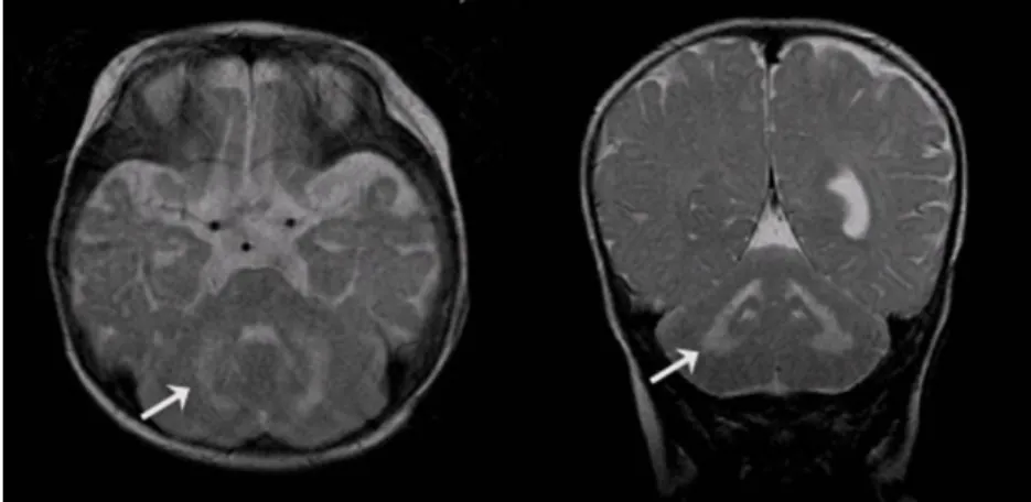 Fig. 3. Direct sequencing of all 17 exons of GALC gene on chromosome 14q31 revealed a c.638_646 del novel mutation in the father(left) and a c.1853T>C known mutation in the mother(right).