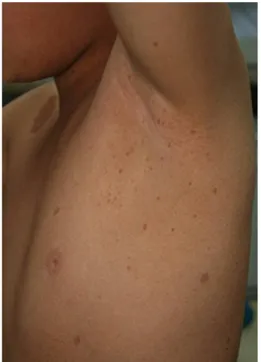 Fig. 1. Multiple café-au-lait spots and axillary freckling.