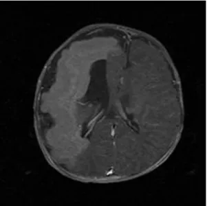 Fig. 3B. Rhythmic theta activities started from right frontal area, which spread to right  hemisp-here during ictal event.