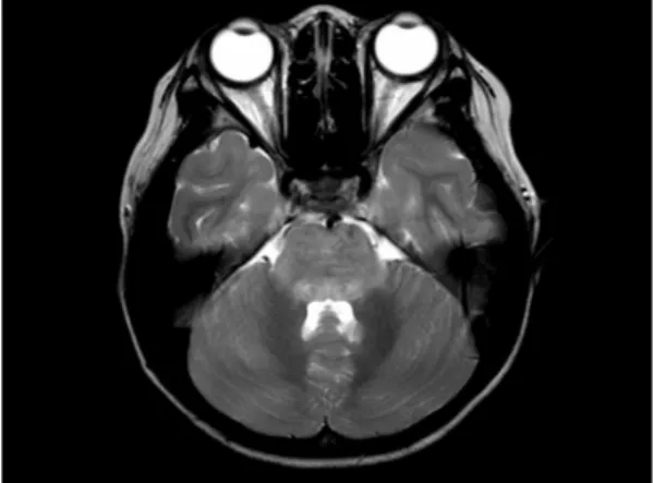 Fig. 1B. Axial T2-weighted brain MRI showed increased signal intensity with edema in left  rec-tus gyrus and midbrain.